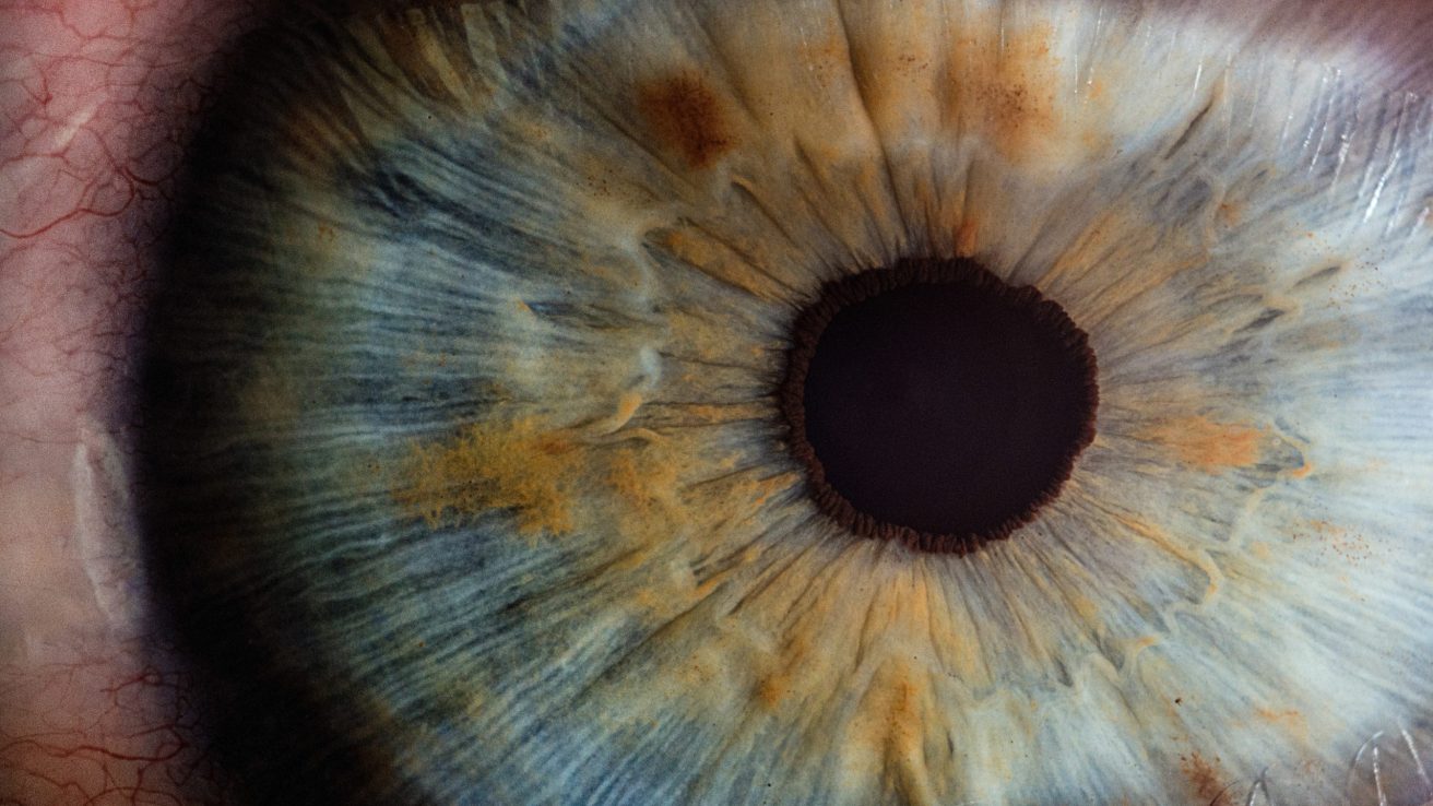 Eye AMD