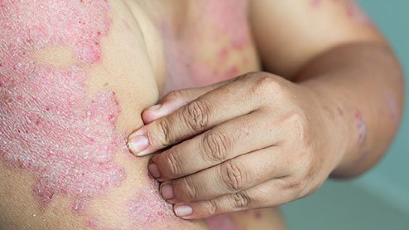 Prevalence Data Suggest Increasing Trend of Psoriasis With Age