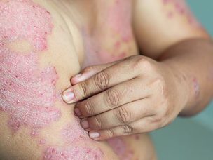 Prevalence Data Suggest Increasing Trend of Psoriasis With Age