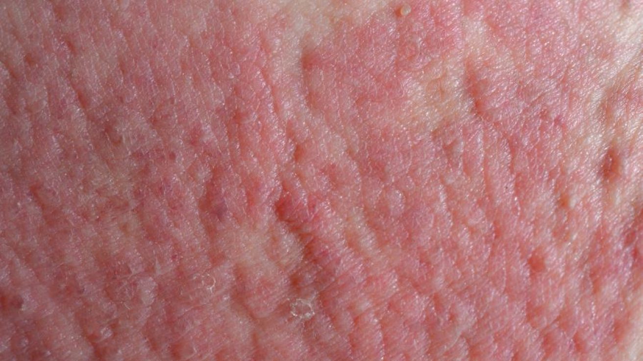 Severe, Active Atopic Eczema Tied to Increased Mortality Risk