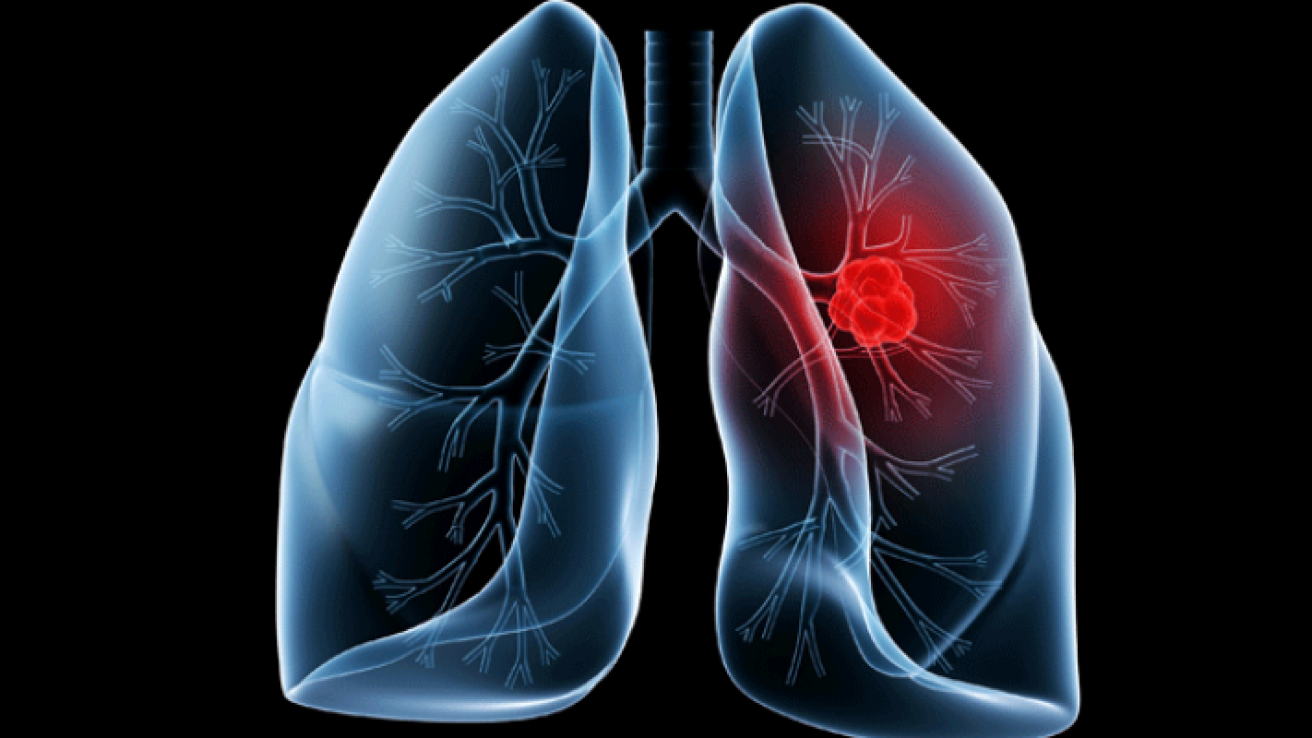 Women Have Lower Risk for Death After Resection for Lung Cancer
