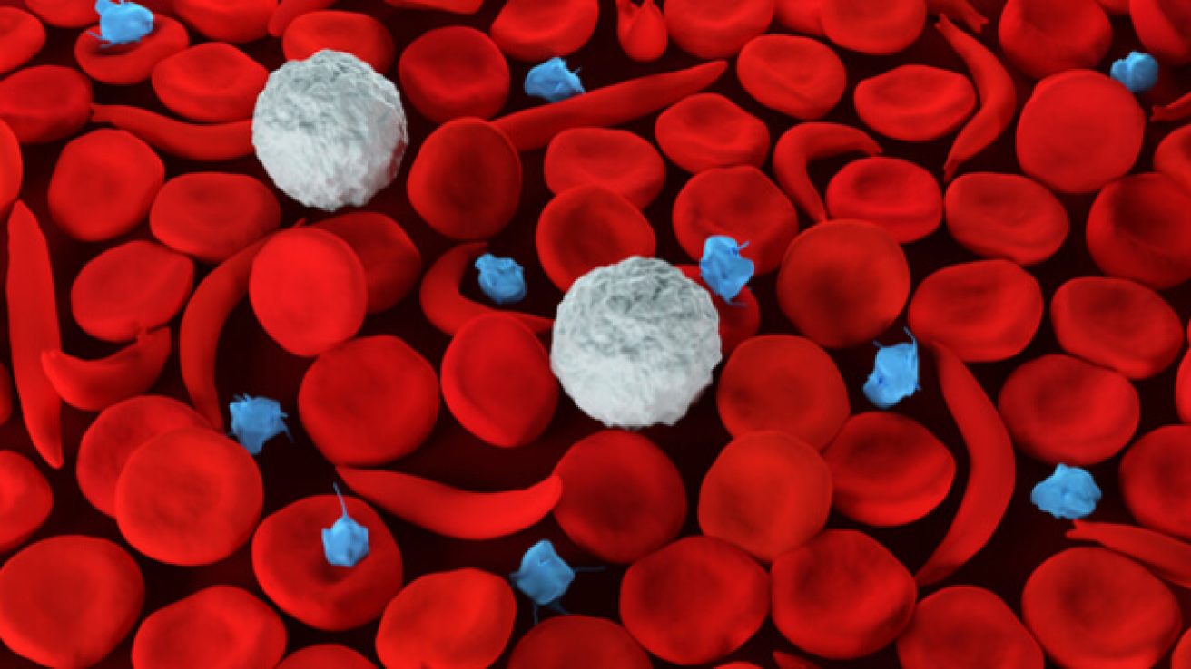 Gene Therapy for Sickle Cell Did Not Cause Patient’s Leukemia