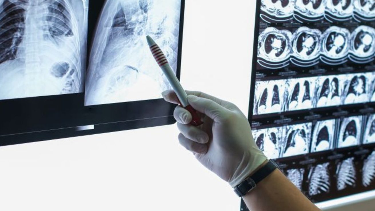 USPSTF Expands Eligibility for Annual Lung Cancer Screening