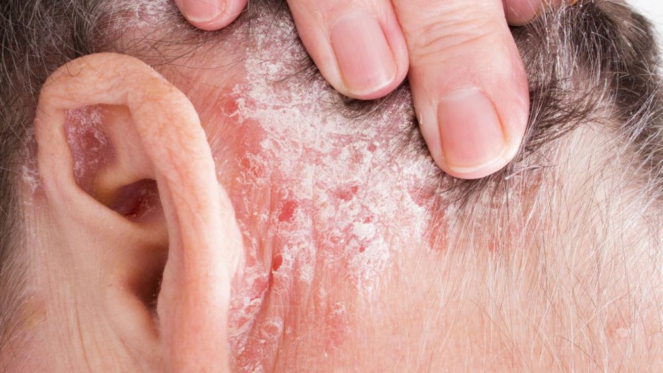 Psoriasis Linked to Higher Risk for Thyroid Disease
