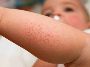 Children With Worse Atopic Dermatitis More Likely to Have Learning Disabilities