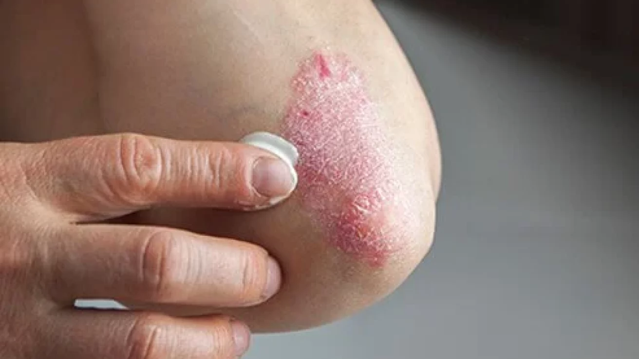 Candidate Biomarkers Identified for Psoriasis Progression
