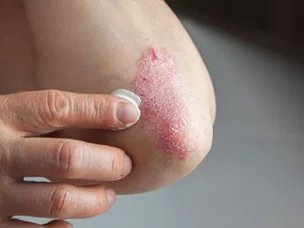 Candidate Biomarkers Identified for Psoriasis Progression