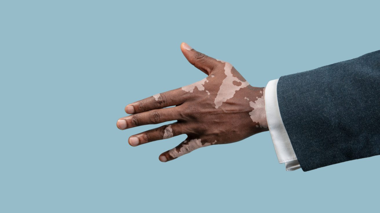 Close up of male hands with vitiligo pigments isolated on blue studio background