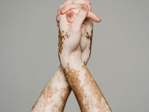 Melanoma Inhibitory Activity (MIA) is an effective therapeutic target for recalcitrant non-segmental vitiligo.