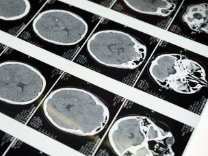 Machine learning-based brain age calculations were found to be significantly predictive biomarkers in patients with NMOSD and RRMS.