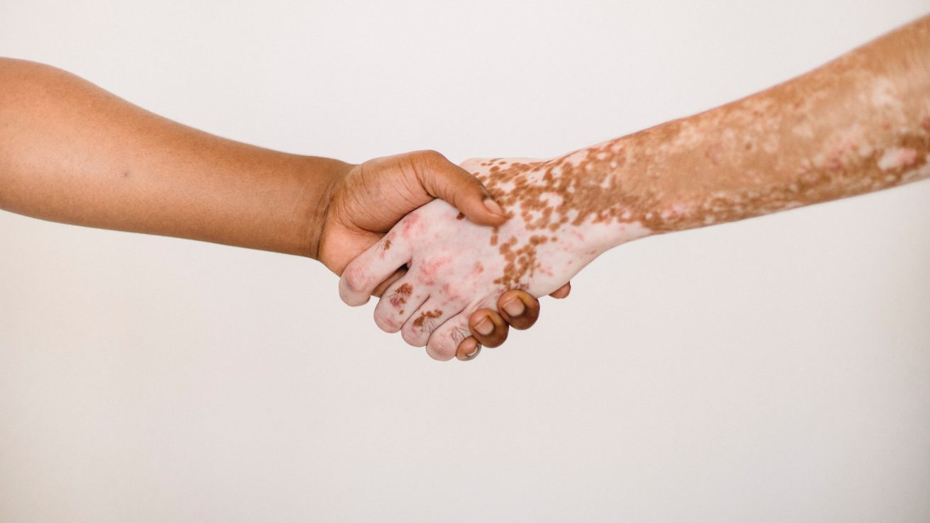 Ruxolitinib, an easy-to-use topical medication for vitiligo has recently been approved by the FDA. The cream can be applied by patients at home, making it a practical option.