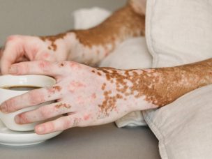 Stable vitiligo skin lesions have a distinct cellular makeup compared to active vitiligo melanocytes due to their unique genetic signatures and metabolic profiles, causing proinflammatory responses and a "stressed" cellular state.