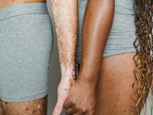 Vitiligo lesions can be treated with antibodies, but off-target effects may be harmful. Injection with a bispecific antibody returns pigmentation only to the area of injection and limits systemic side effects.