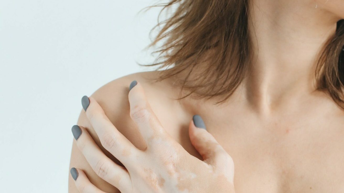 Individuals diagnosed with vitiligo have significantly greater levels of anti-thyroid peroxidase and anti-thyroglobulin antibodies, which are the markers of autoimmune thyroid diseases.