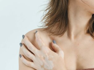 Individuals diagnosed with vitiligo have significantly greater levels of anti-thyroid peroxidase and anti-thyroglobulin antibodies, which are the markers of autoimmune thyroid diseases.