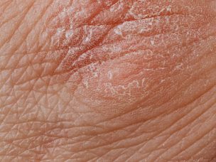 Dietary inflammatory index not linked to psoriasis in participants with different population settings