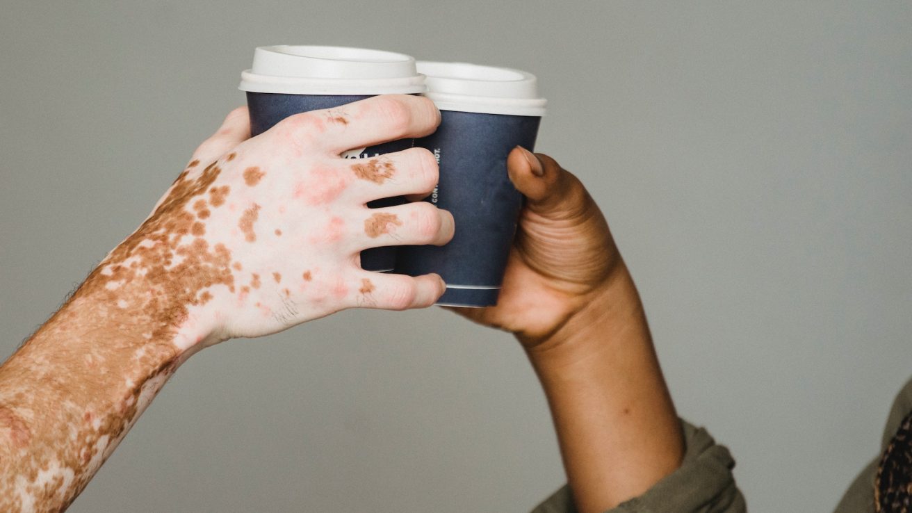 The success of treating vitiligo depends on multiple factors, including genetics and the facility's experience. Surgical treatments like tissue and cellular grafting are the most important therapeutic options for patients with stable vitiligo that don't respond to other therapies.