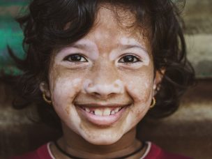 A young girl with vitiligo smiling at the camera