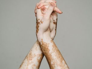 Despite the lack of pigmentation, people with vitiligo are at less risk for getting skin cancer, possibly due to increased rates of DNA repair, according to this study.