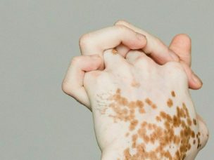Recent research suggests that a combination of micro-needling and topical 5-fluorouracil could offer better outcomes for vitiligo patients compared to using topical tacrolimus alone. This may be a vital step towards more effective vitiligo management.