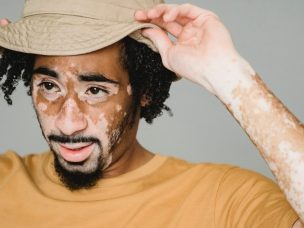 Recent studies suggest that trained immunity, a state of heightened immune response, could affect vitiligo. This new perspective could greatly impact our understanding of vitiligo's progression and change how we approach new treatment options.