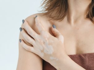 Recent research shows a potential link between vitiligo and systemic sclerosis, a chronic skin and organ condition. Understanding these findings may help you stay informed about your health if you have vitiligo.