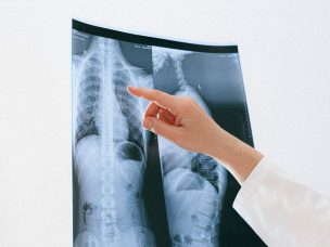Vertebral fractures, underrecognized as pathological, were main cause of irreversible organ damage