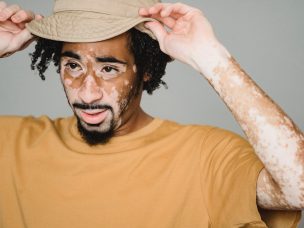 A man with Vitiligo putting on a bucket hat