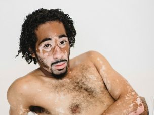 A recent study examined the prevalence of vitiligo and the quality of life of vitiligo patients in the United States, Japan, and Europe.