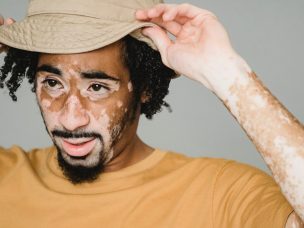 Finding the right treatment for vitiligo can be a process. One study looked at two treatments combined with an ultraviolet light therapy called NB-UVB. Both treatments showed promise, with some areas of the body responding better than others.