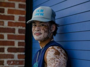 If you or someone you know has vitiligo, learning about available treatments like depigmentation therapy can be empowering. This therapy can offer many benefits, but like all treatments, it has its challenges. Here, we’ll explore what a recent study says about the pros and cons of depigmentation therapy.
