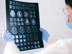 Brain MRI volumetric measurements are a better predictor of cognitive performance than neurofilament light chain levels in multiple sclerosis, according to a recent 10-year follow-up study.